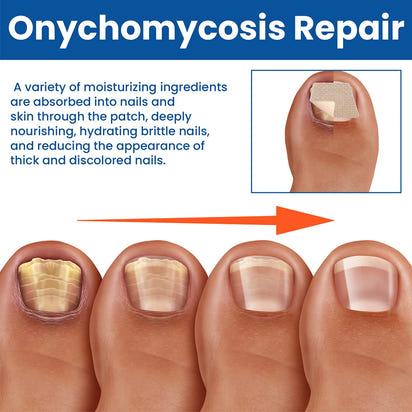 Kerava Nail Renewal Patches