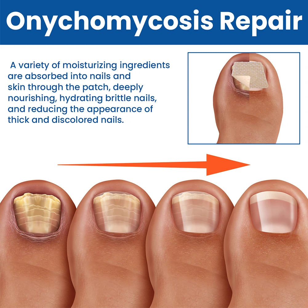 Kerava Nail Renewal Patches